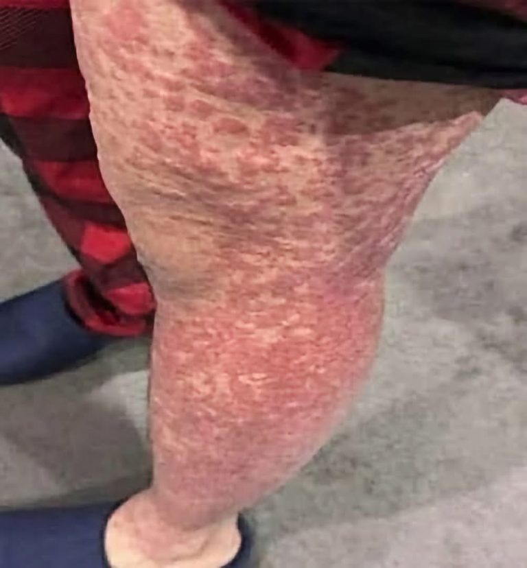 Manchas rojas en las piernas: posibles causas, síntomas y cuándo acudir al médico
