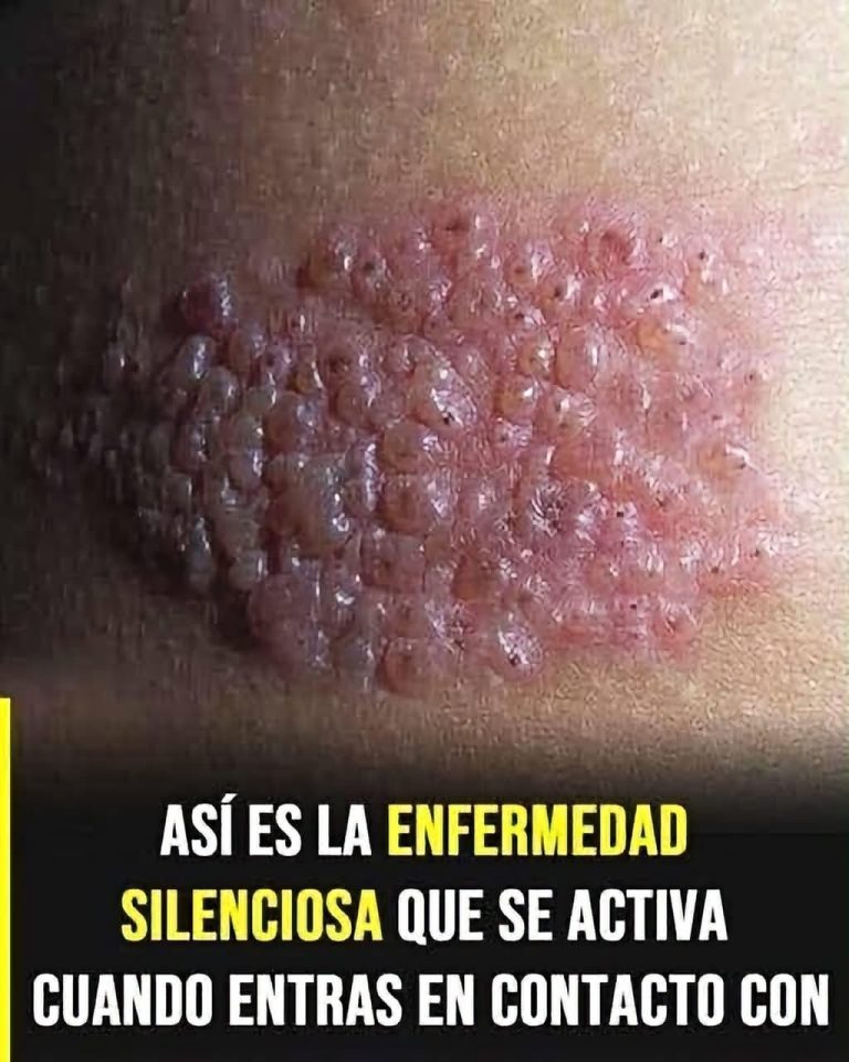 Herpes zóster o culebrilla: síntomas, causas y cuándo acudir al médico