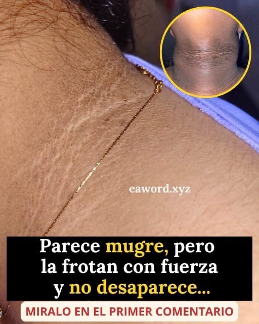 Parece suciedad, pero no desaparece al lavar el cuello: ¿qué podría indicar este cambio en la piel?