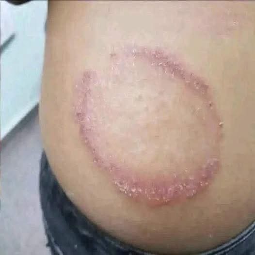 Tiña en la piel: síntomas, cómo se contagia, tratamiento y cuándo acudir al médico