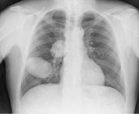 Radiografía con una masa en el pulmón: qué puede significar realmente y por qué no debes sacar conclusiones solo por una imagen