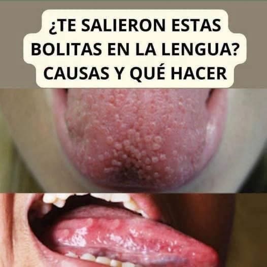 ¿Tienes pequeñas bolitas en la lengua? Estas son las causas más comunes y cuándo debes consultar al médico