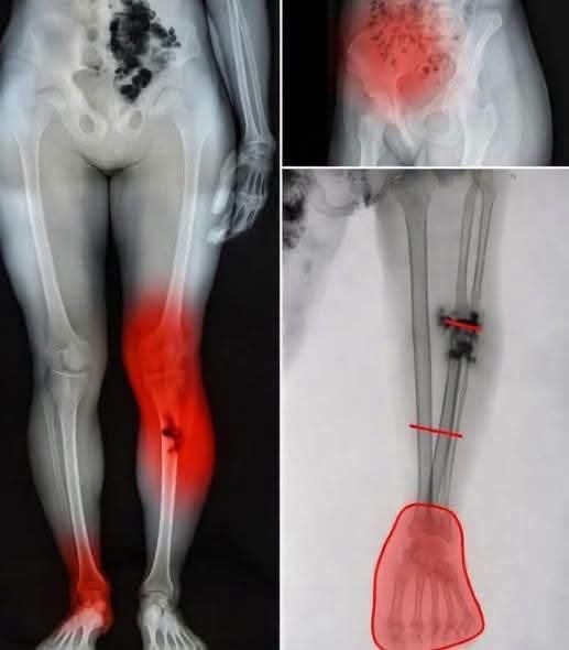 ¿Las vacunas contra la COVID-19 dañan los huesos o las piernas? Esto es lo que dice la evidencia científica
