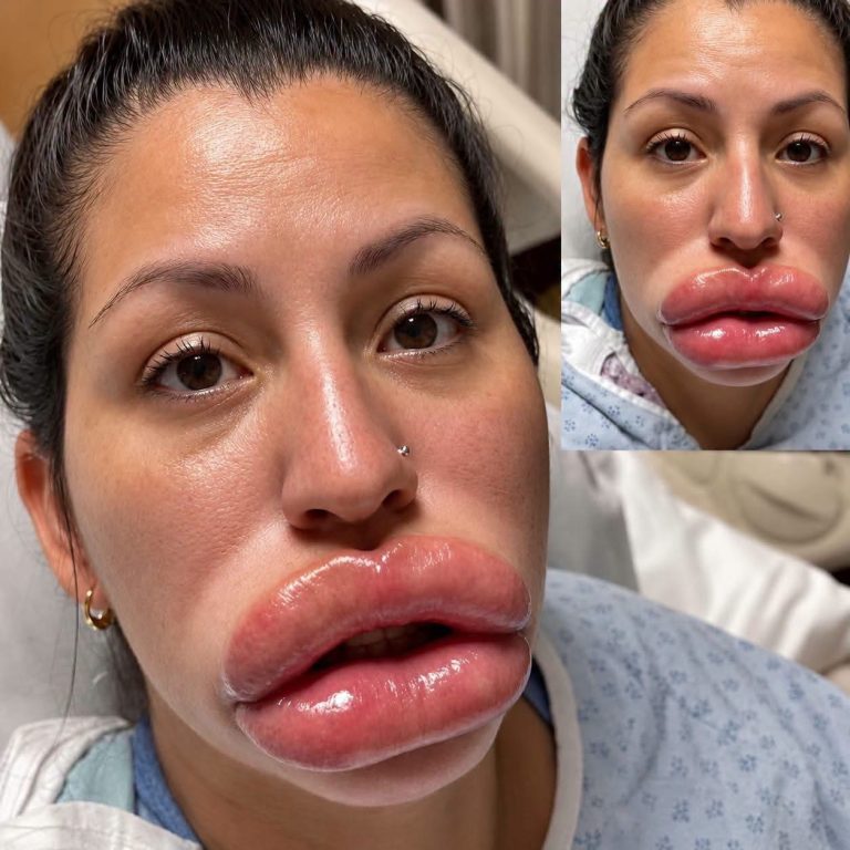 ¿Qué pasa si un relleno de labios sale mal? Riesgos, complicaciones y señales de alerta que no debes ignorar
