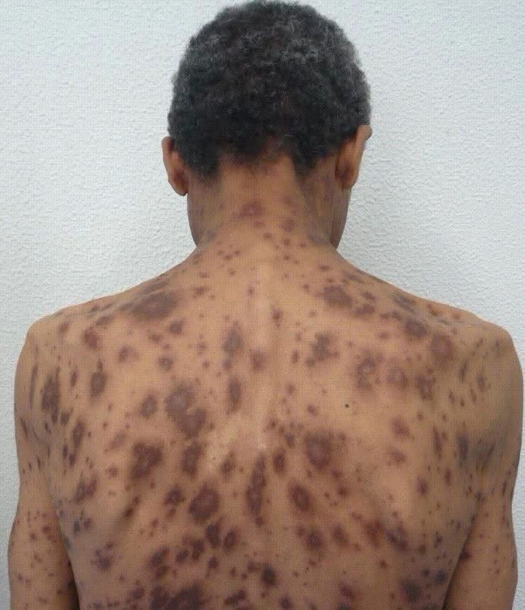 ¿Por qué aparecen manchas oscuras en la piel? Estas son las causas más frecuentes, según la dermatología
