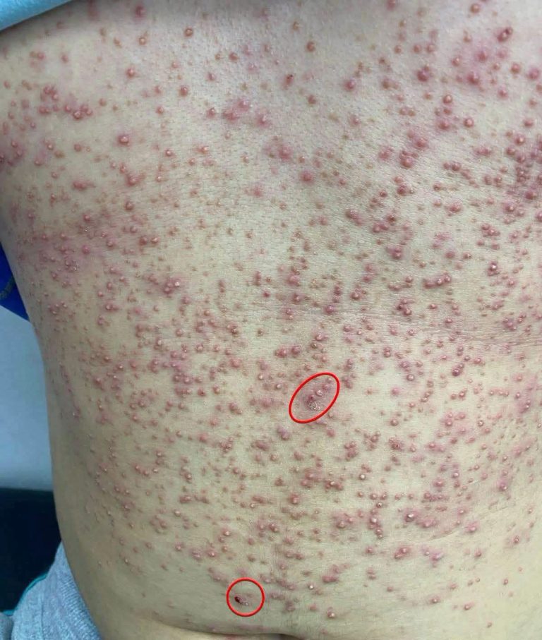 ¿Tienes pequeñas lesiones o ampollas en la espalda? Estas son las causas más frecuentes y cuándo debes consultar al médico