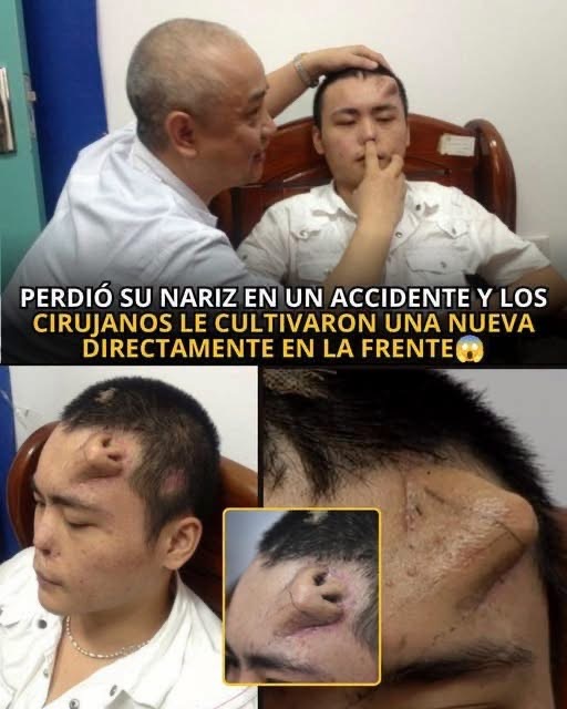 El sorprendente caso del joven que perdió su nariz y los médicos lograron reconstruirla haciéndola crecer en su frente