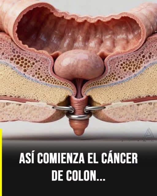 ¿Así comienza el cáncer de colon? Lo que realmente puede confirmarse sobre la imagen viral
