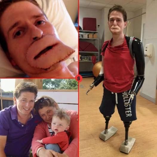 ¿Qué ocurrió realmente? La verdad detrás de la imagen viral del hombre que perdió sus extremidades