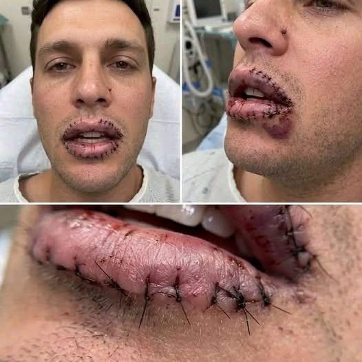 Joven aparece con graves lesiones en los labios y genera preocupación en redes: esto es lo que realmente se sabe