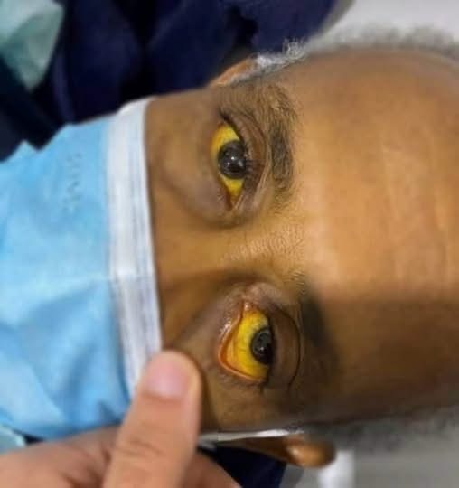 Ojos amarillos: posibles causas, síntomas y cuándo acudir de inmediato al médico