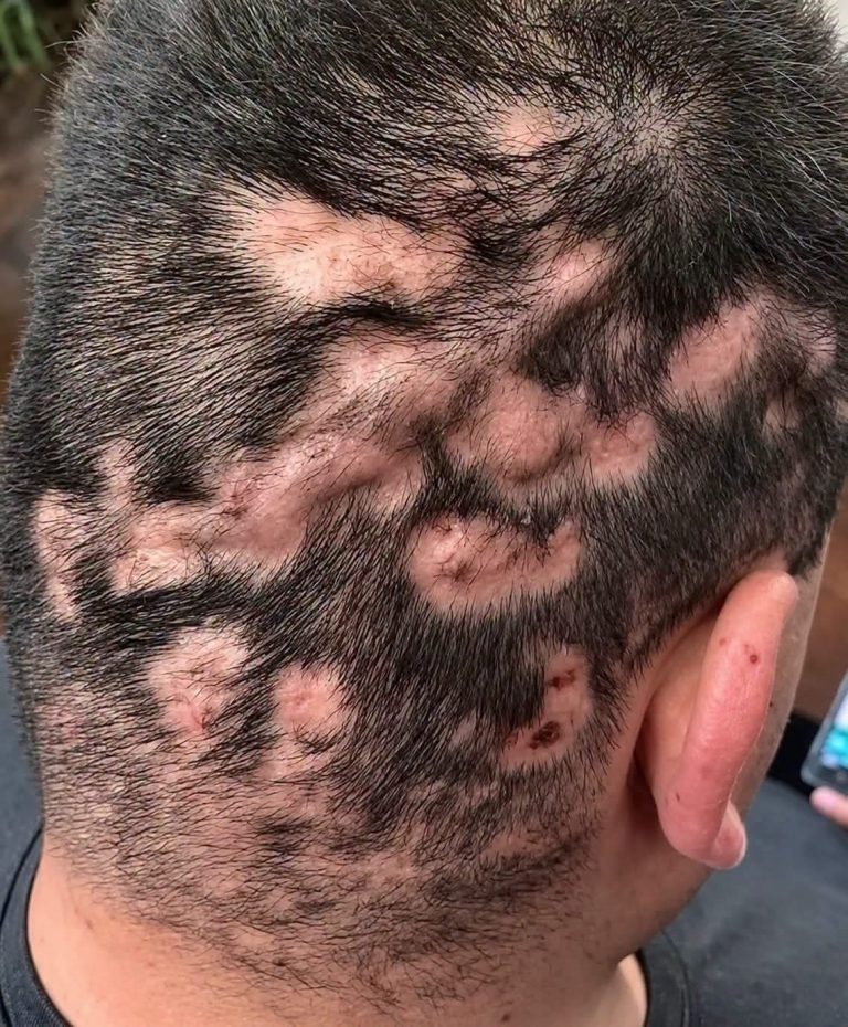 Pérdida de cabello en parches: posibles causas, síntomas y cuándo acudir al dermatólogo