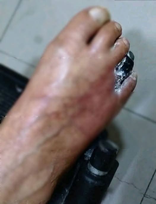 ¿Pies hinchados? Estas son algunas de las posibles causas y cuándo debes acudir al médico