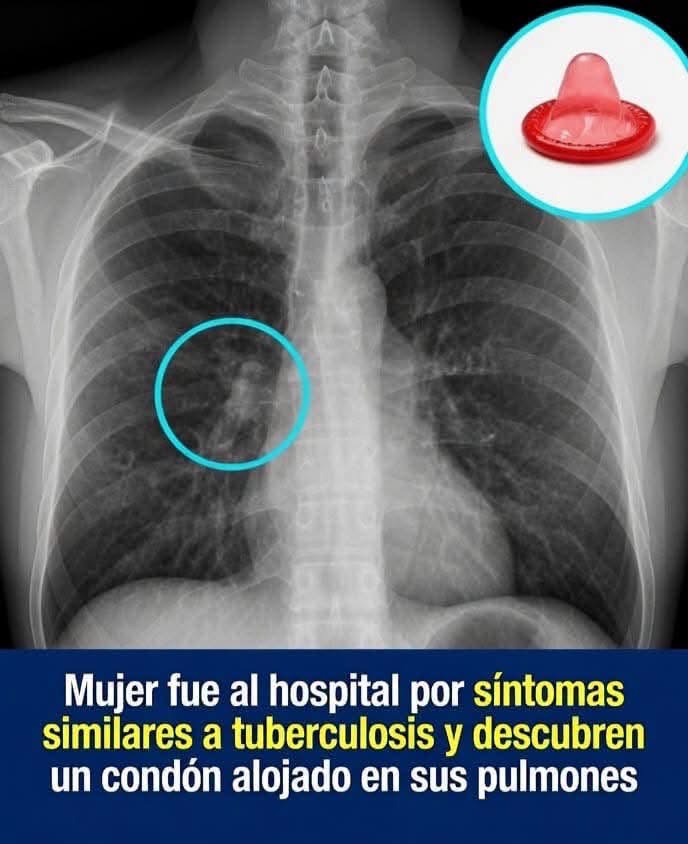 ¿Es posible que un objeto llegue a los pulmones? El caso viral que ha generado miles de reacciones