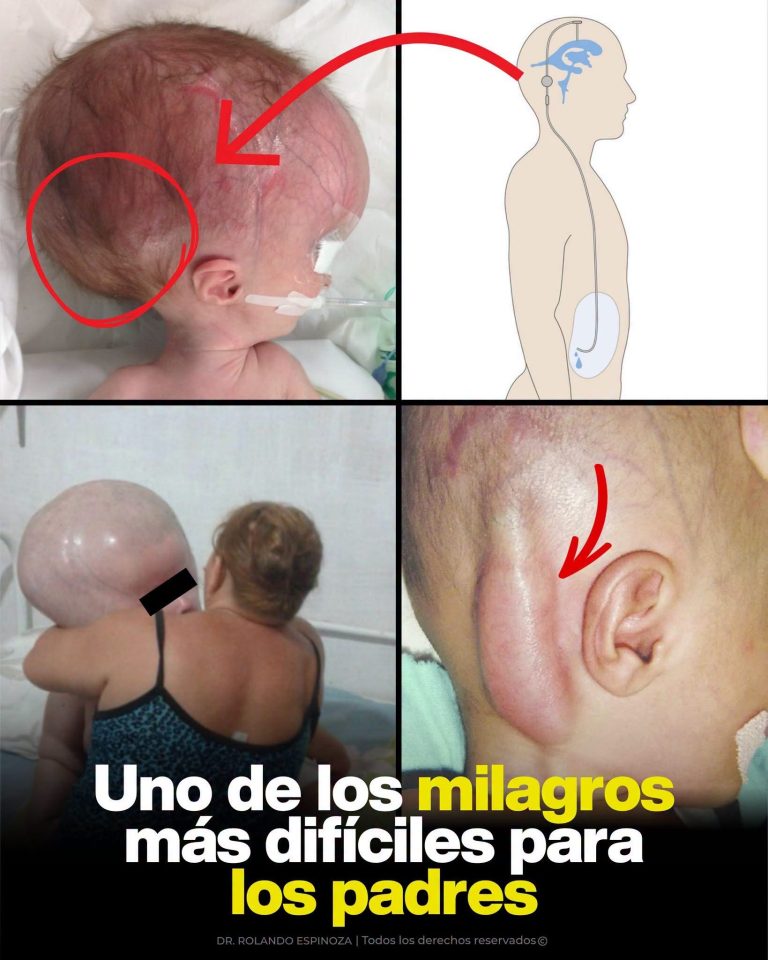 Hidrocefalia infantil: qué es, cuáles son sus síntomas y por qué el diagnóstico temprano puede cambiar vidas