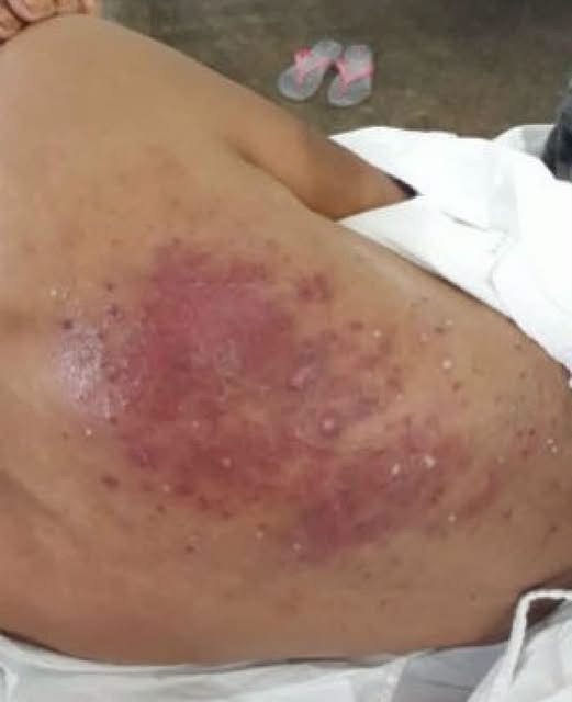 ¿Dormir sin pijama puede causar lesiones en la piel? La verdad sobre los abscesos, la celulitis y las manchas dolorosas
