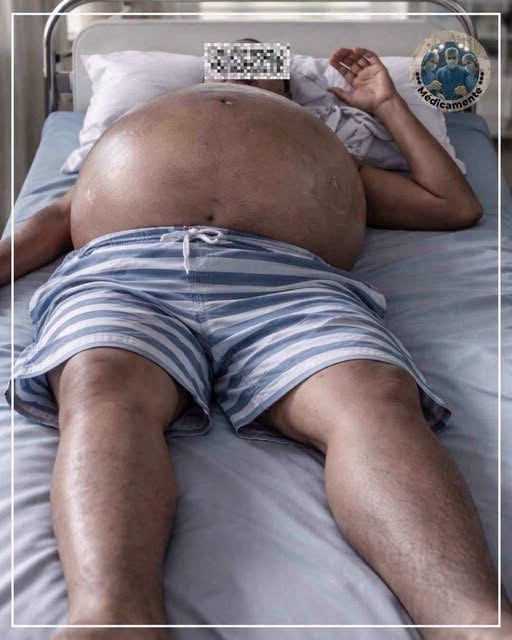 Así puede verse el abdomen de una persona con ascitis: la grave complicación que puede aparecer tras años de consumo excesivo de alcohol