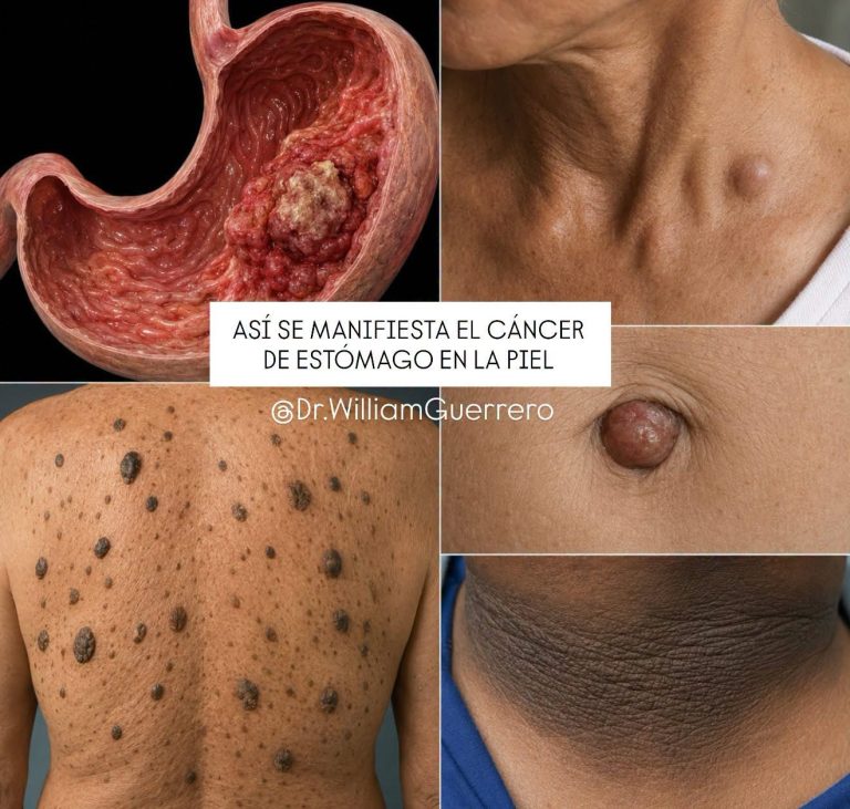 ¿El cáncer de estómago puede manifestarse en la piel? Señales reales, mitos y cuándo consultar