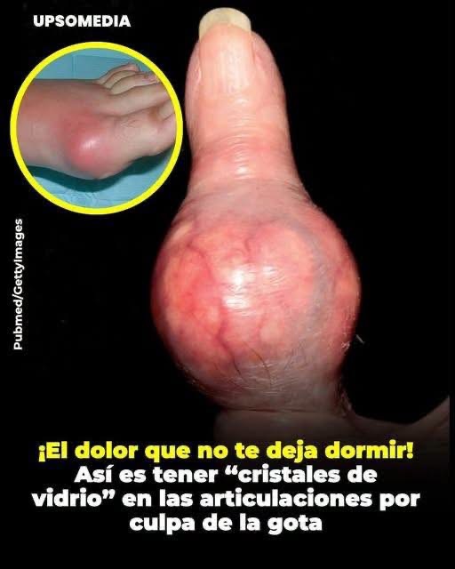 Nadie te advierte sobre este doloroso ataque nocturno: podría tratarse de gota