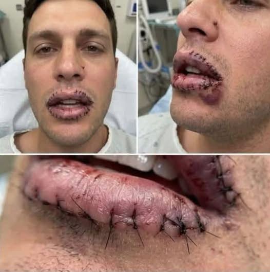 Luego de comer pollo frito su boca comenzó a hincharse: estas podrían ser las causas