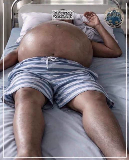 Ascitis y consumo excesivo de alcohol: por qué puede aumentar el abdomen