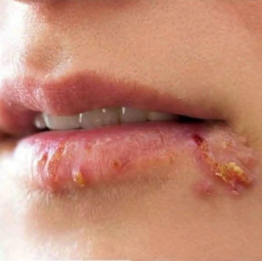 Estas lesiones en los labios pueden revelar una infección muy común