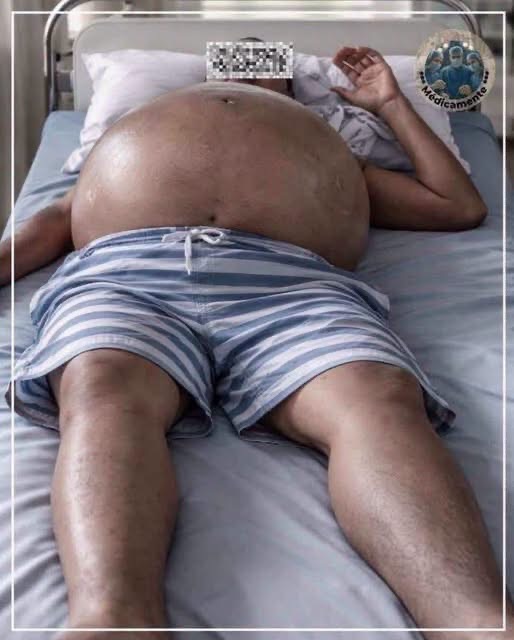 Así puede manifestarse la acumulación extrema de líquido en el abdomen