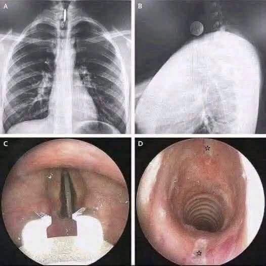 Una imagen médica causa alarma entre vacunados: esto es lo que realmente muestra
