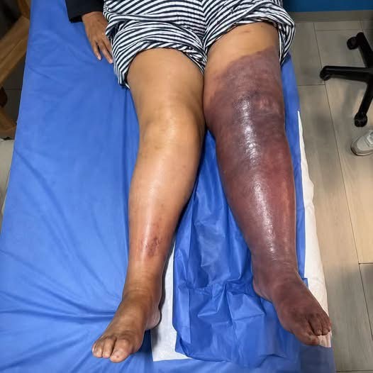 Una pierna hinchada y morada puede indicar una urgencia vascular: esto debes saber