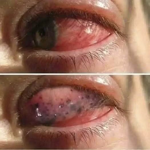 ESTAS SON LAS CONSECUENCIAS DE DORMIR CON LENTES DE CONTACTO… UNA COSTUMBRE QUE PUEDE AFECTAR SERIAMENTE LOS OJOS