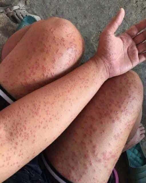 CONSECUENCIAS DE DORMIR SIN CAMBIAR LAS SÁBANAS DURANTE MUCHO TIEMPO… ESTO ES LO QUE PODRÍA OCURRIR EN TU PIEL