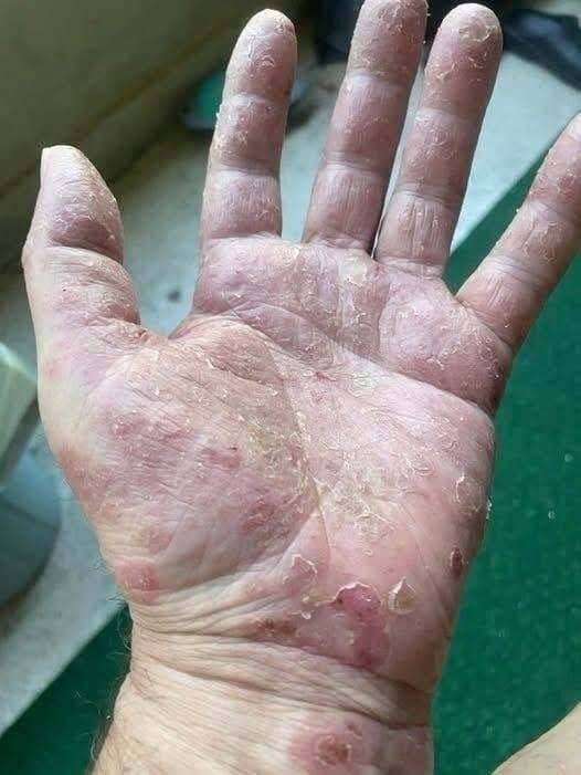 ESTAS SEÑALES EN LAS MANOS NO SIGNIFICAN AUTOMÁTICAMENTE CÁNCER: ESTO ES LO QUE PUEDEN INDICAR