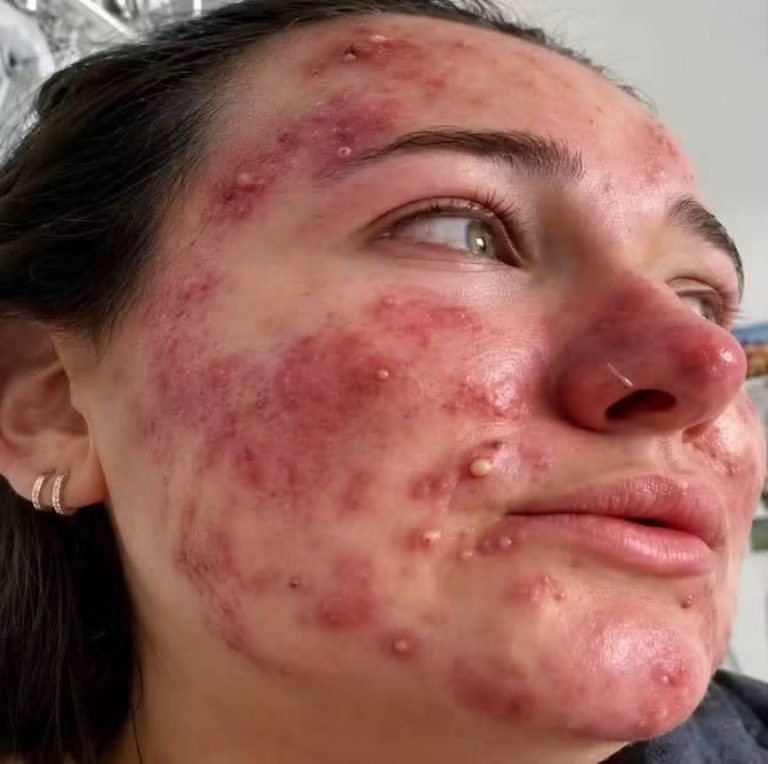 Dormir sin limpiar bien el rostro puede empeorar el acné y la irritación de la piel