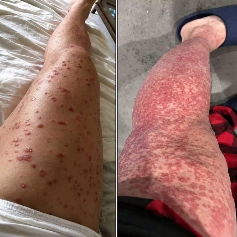 Manchas y lesiones en las piernas: qué pueden significar y cuándo buscar atención médica